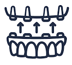 Advanced All-on-4 and All-on-6 Implant Services
